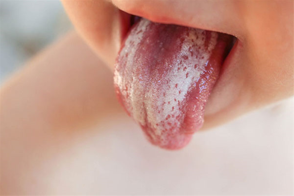 Cha mẹ nên làm gì khi trẻ bị tưa lưỡi?